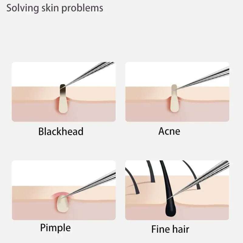 1/11Pcs Acne Pimples Blackhead Remover Clip Ultra-fine Tweezers Black Dots Blackhead Extractor Acne Needle Facial Cleaner Skin