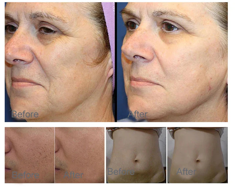 2-in-1 Plasma Skin Care Device – Hot & Cold Lifting Machine